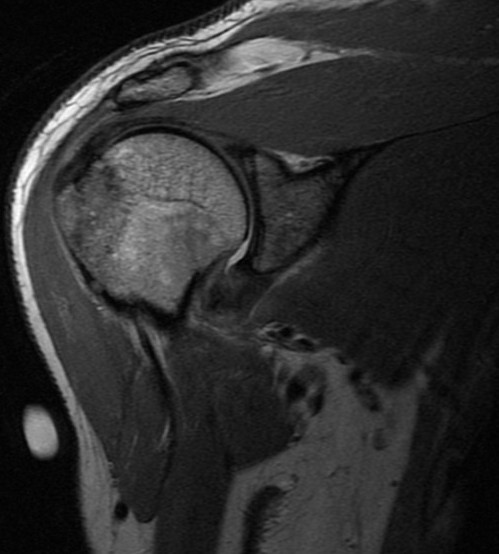 Figure 2 for case Greater tuberosity fracture and capsular sprain